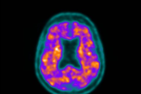 11C-Pittsburgh Compound B